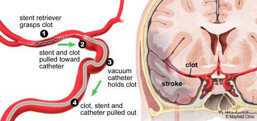 Removing clots with new retrieval technologies